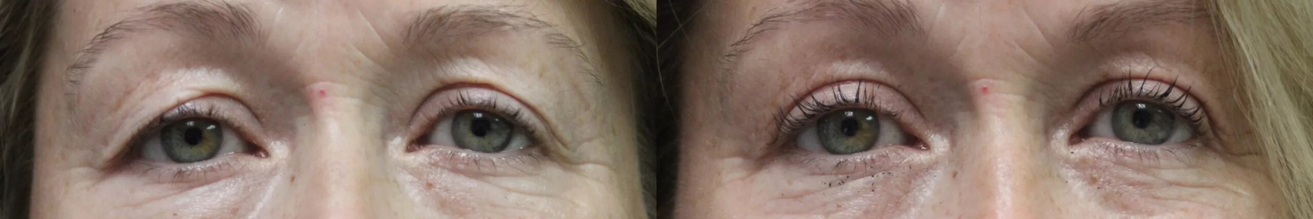 Moratis plastic surgery blepharoplasty patient 12