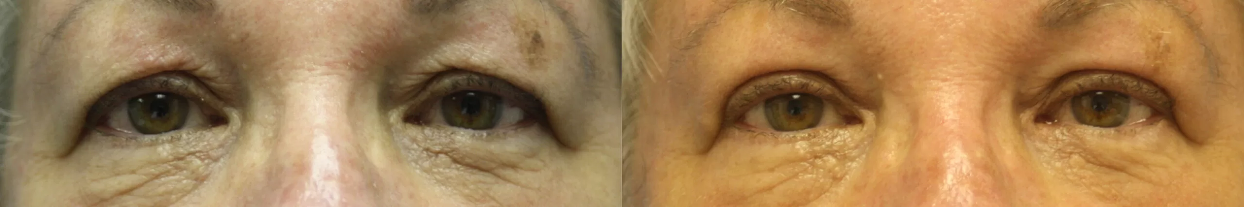 Moratis plastic surgery blepharoplasty patient 13