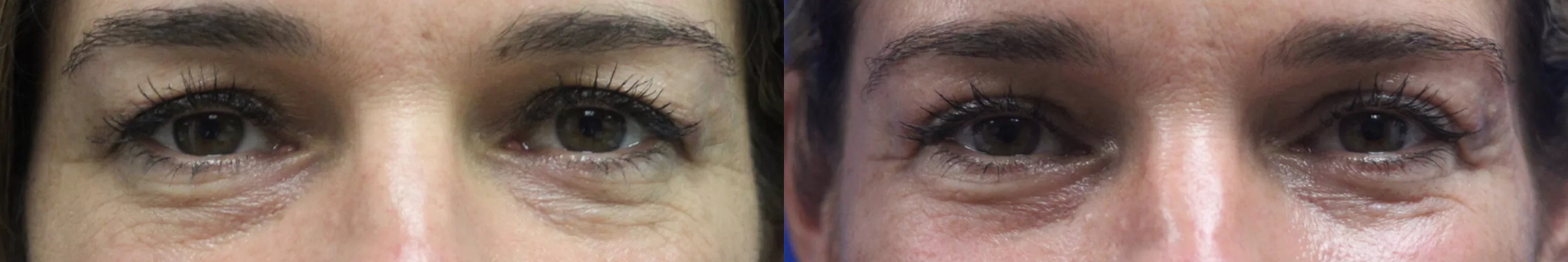 Moratis plastic surgery blepharoplasty patient 14