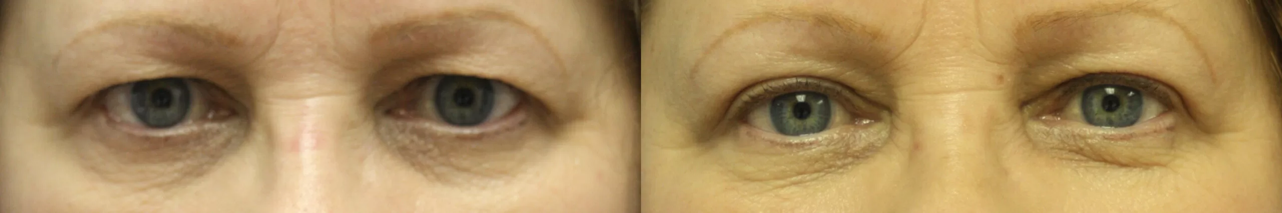 Moratis plastic surgery blepharoplasty patient 15