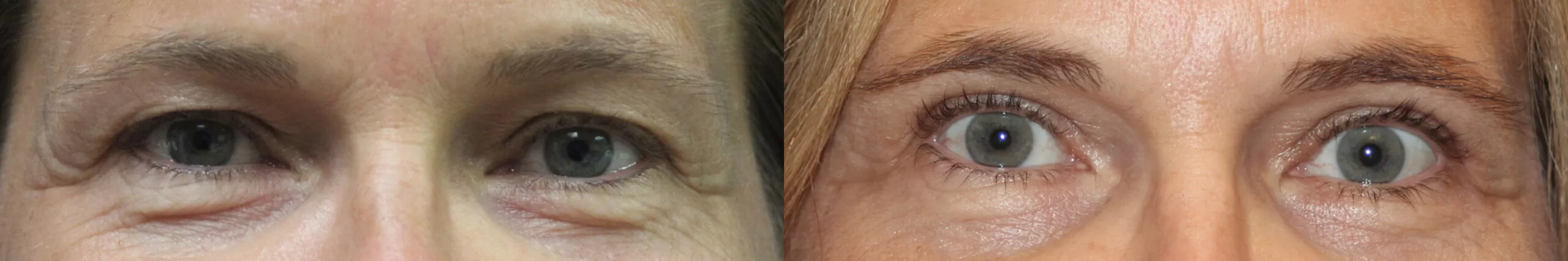 Moratis plastic surgery blepharoplasty patient 16