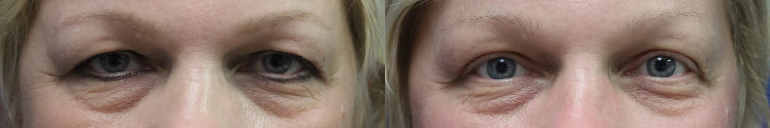 Moratis plastic surgery blepharoplasty patient 17