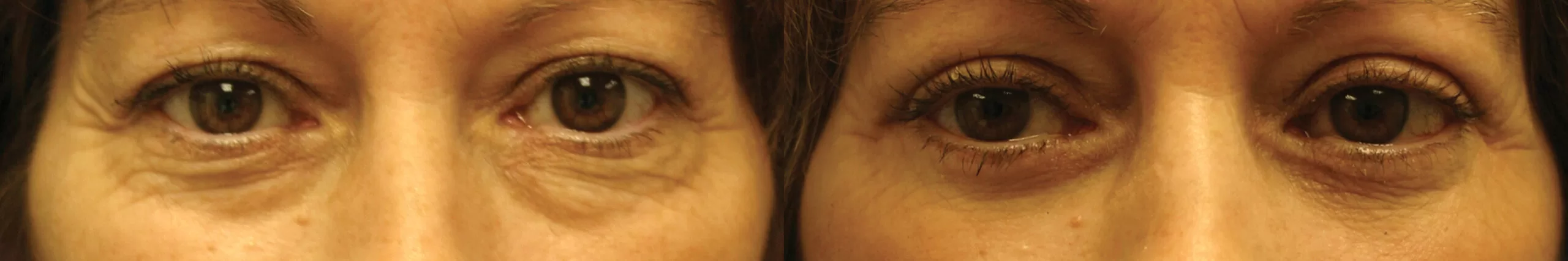 Moratis plastic surgery blepharoplasty patient 18