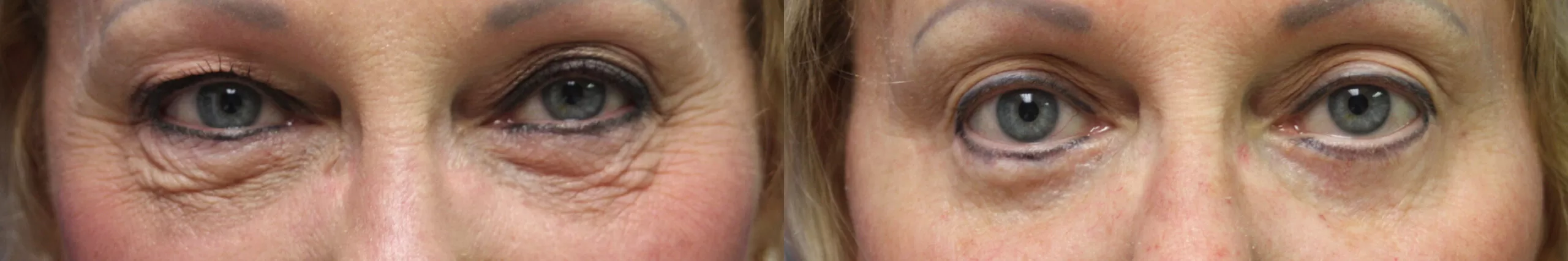 Moratis plastic surgery blepharoplasty patient 19