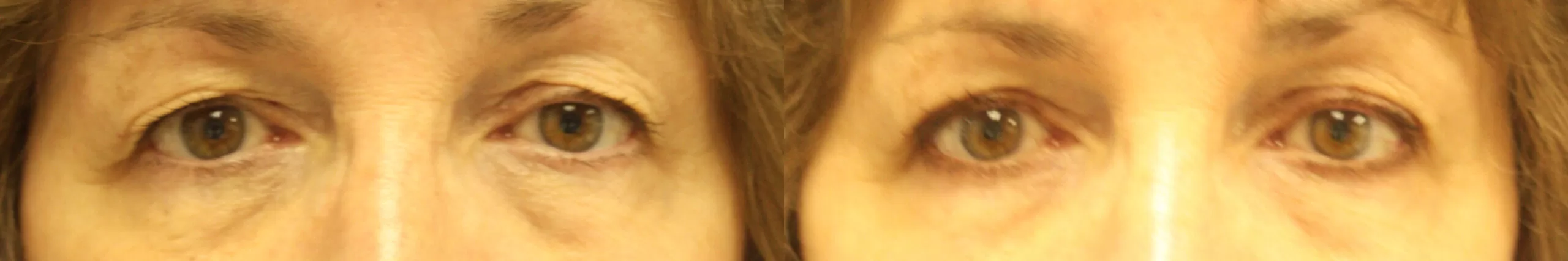 Moratis plastic surgery blepharoplasty patient 20