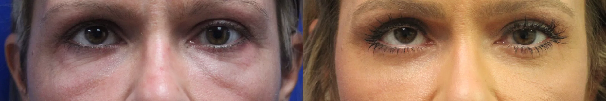 Moratis plastic surgery blepharoplasty patient 5