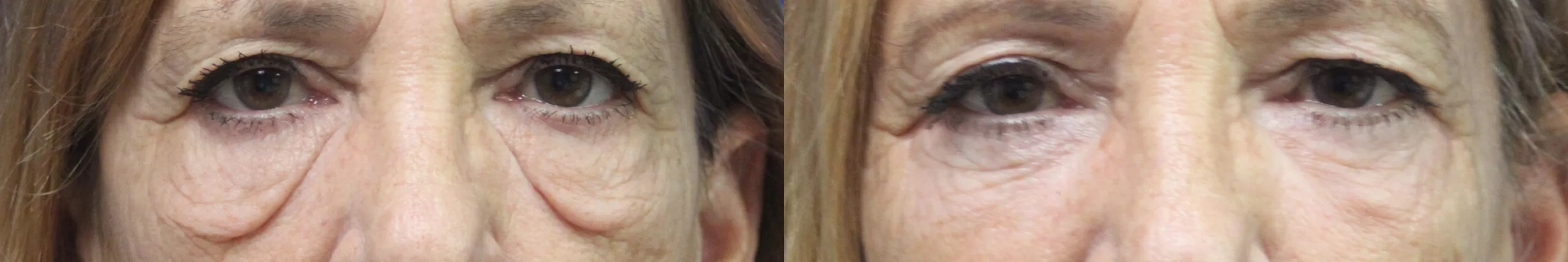 Moratis plastic surgery blepharoplasty patient 6
