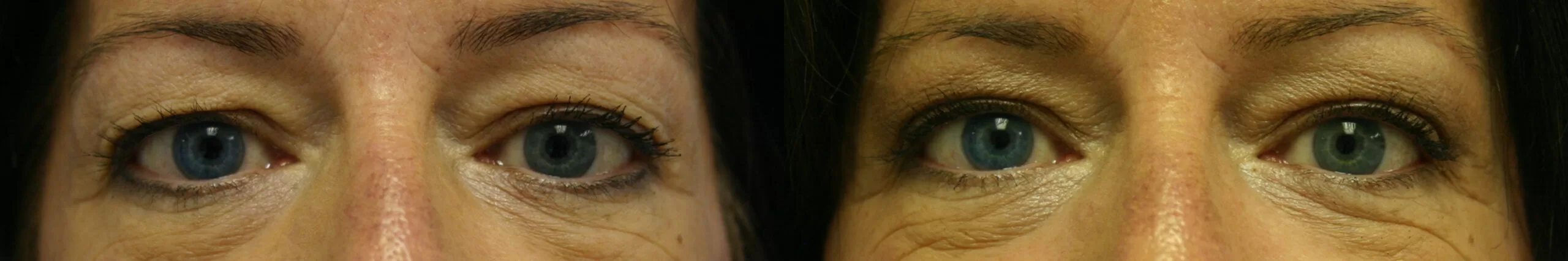 Moratis plastic surgery blepharoplasty patient 7