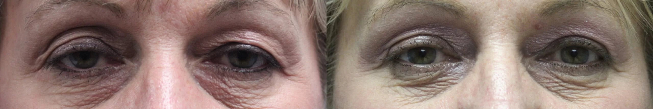 Moratis plastic surgery blepharoplasty patient 8