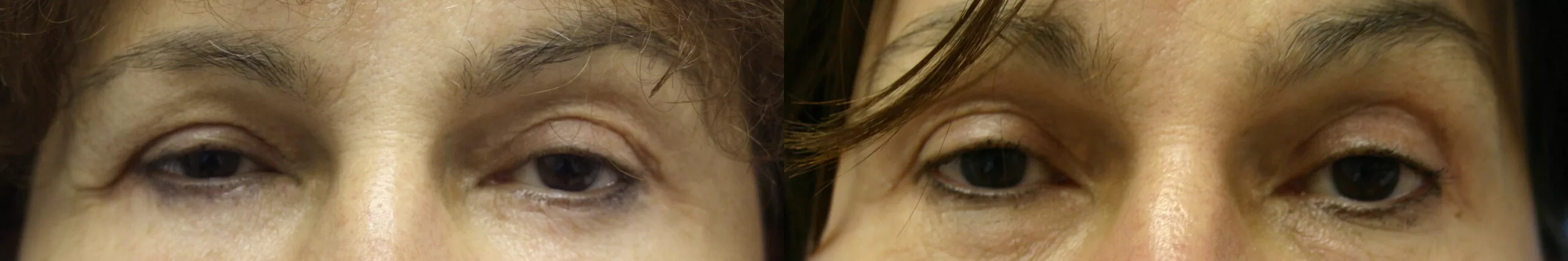 Moratis plastic surgery blepharoplasty patient 9