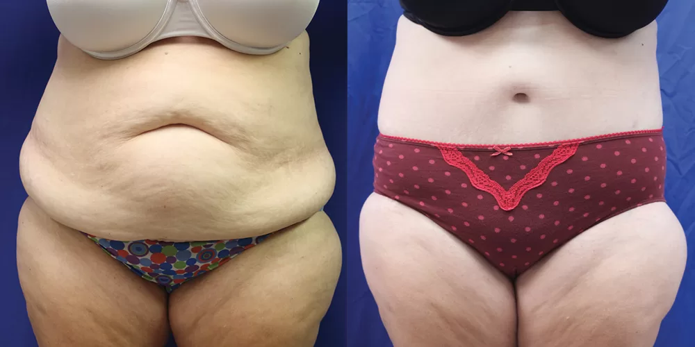 Moratis plastic surgery body lift patient 6a