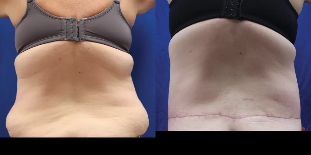 Moratis plastic surgery body lift patient 6b
