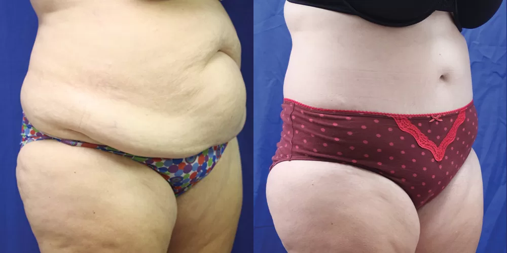 Moratis plastic surgery body lift patient 6c