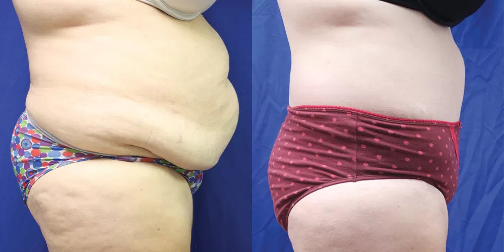 Moratis plastic surgery body lift patient 6d