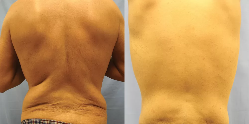 Moratis plastic surgery body lift patient 7b