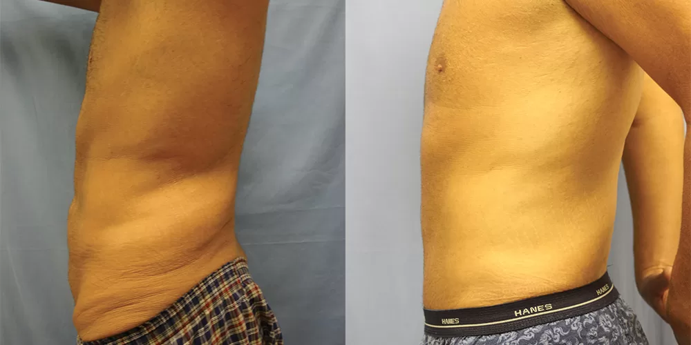 Moratis plastic surgery body lift patient 7c