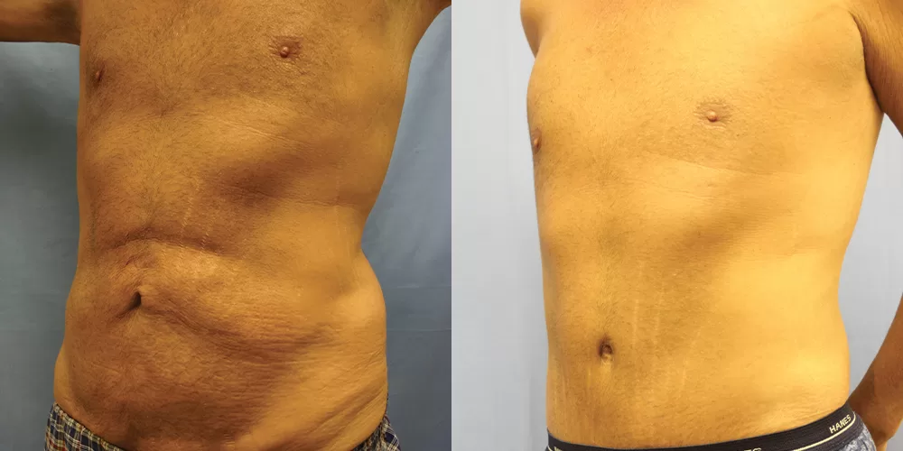 Moratis plastic surgery body lift patient 7d