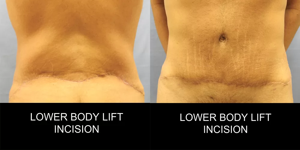 Moratis plastic surgery body lift patient 7e