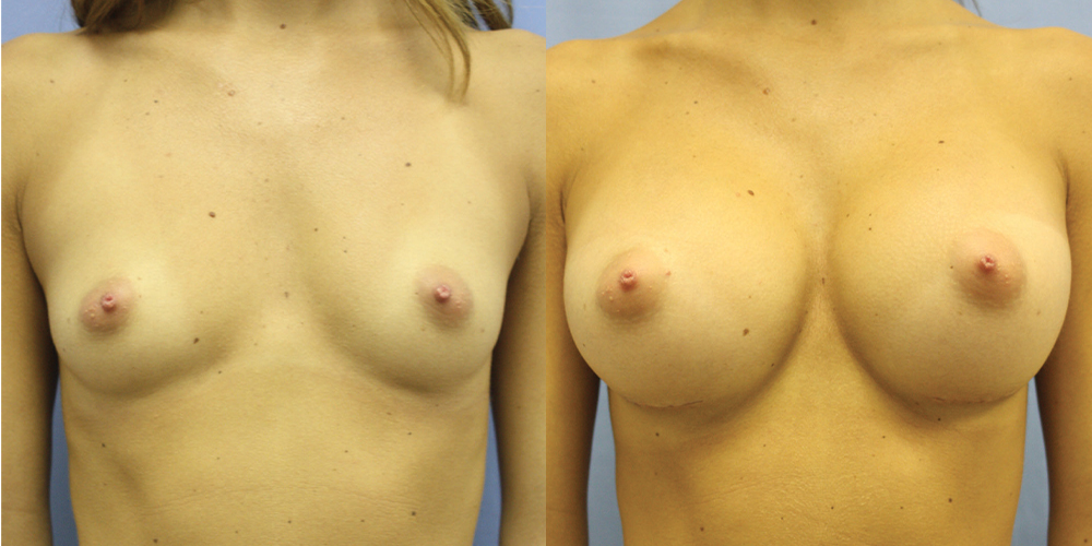 Patient 33a Breast Augmentation Before and After