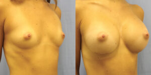 Patient 33b Breast Augmentation Before and After