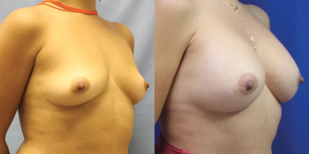 Patient 34b breast augmentation before and after