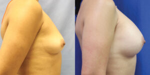 Patient 34c Breast Augmentation Before and After