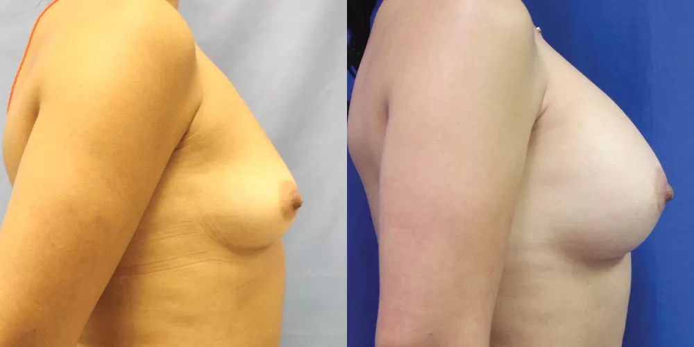 Patient 34c breast augmentation before and after