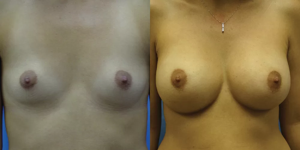 Patient 35a breast augmentation before and after