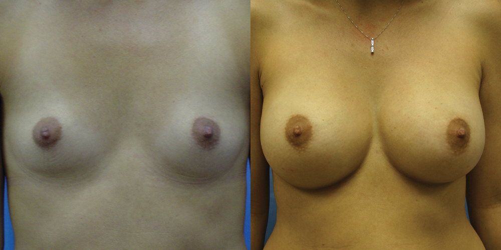 Patient 35a Breast Augmentation Before and After