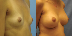 Patient 35b Breast Augmentation Before and After