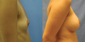 Patient 35c Breast Augmentation Before and After