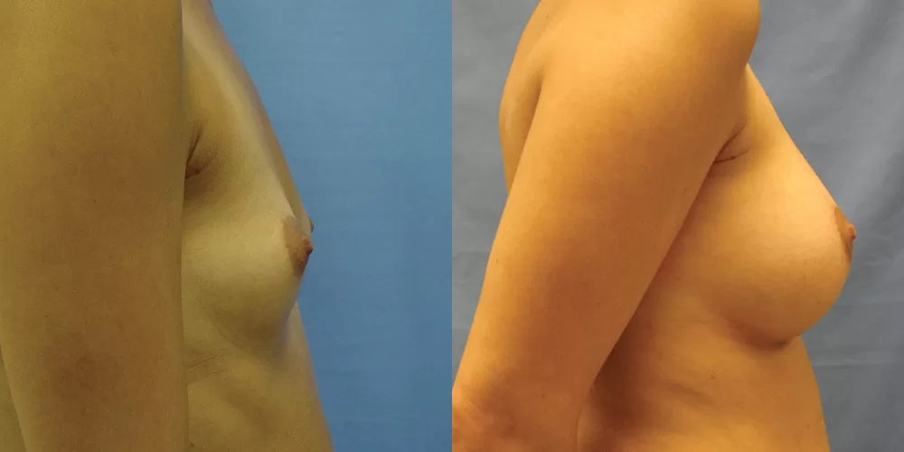 Patient 35c breast augmentation before and after