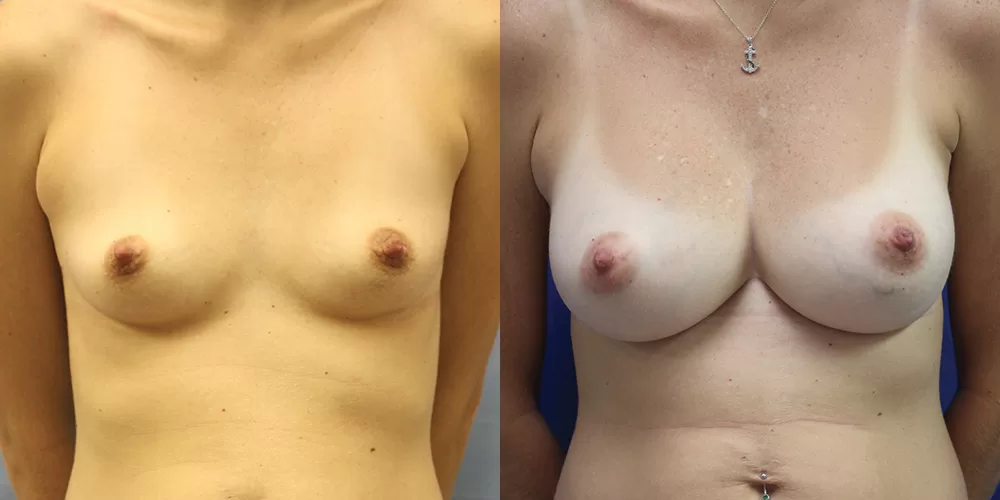 Patient 36a breast augmentation before and after