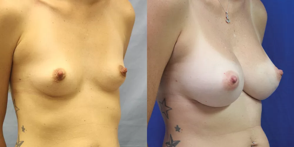 Patient 36b breast augmentation before and after