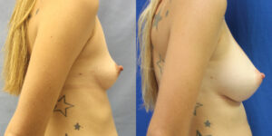 Patient 36c Breast Augmentation Before and After