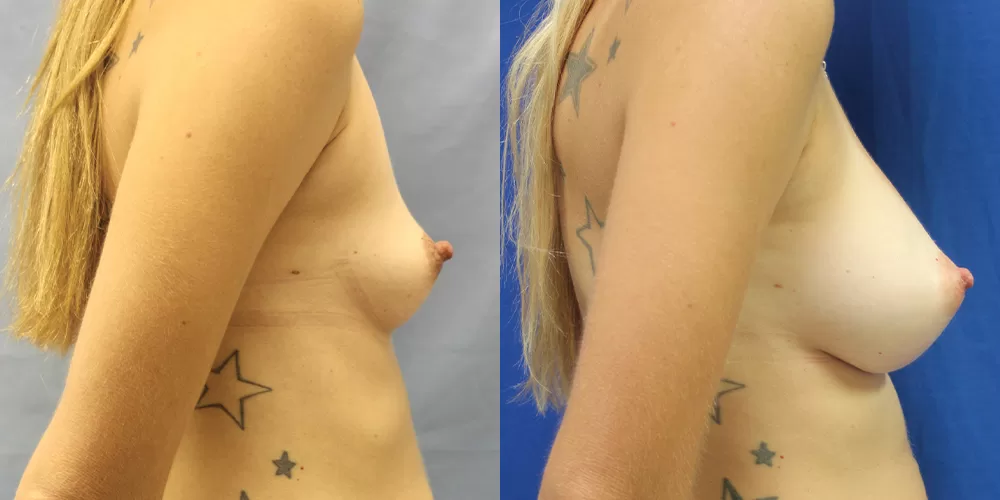 Patient 36c breast augmentation before and after