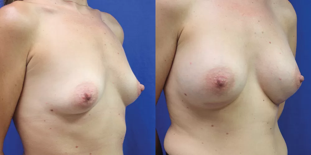 Patient 37b breast augmentation before and after