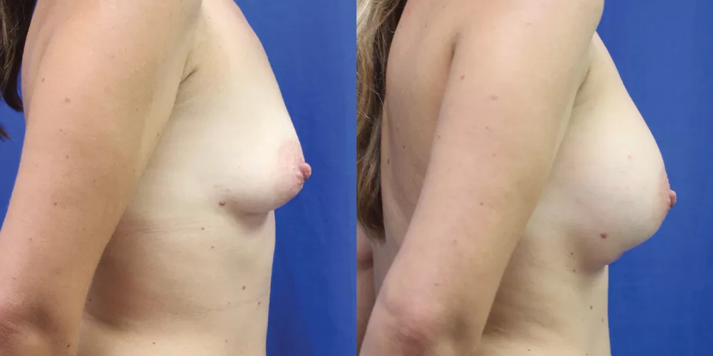 Patient 37c breast augmentation before and after