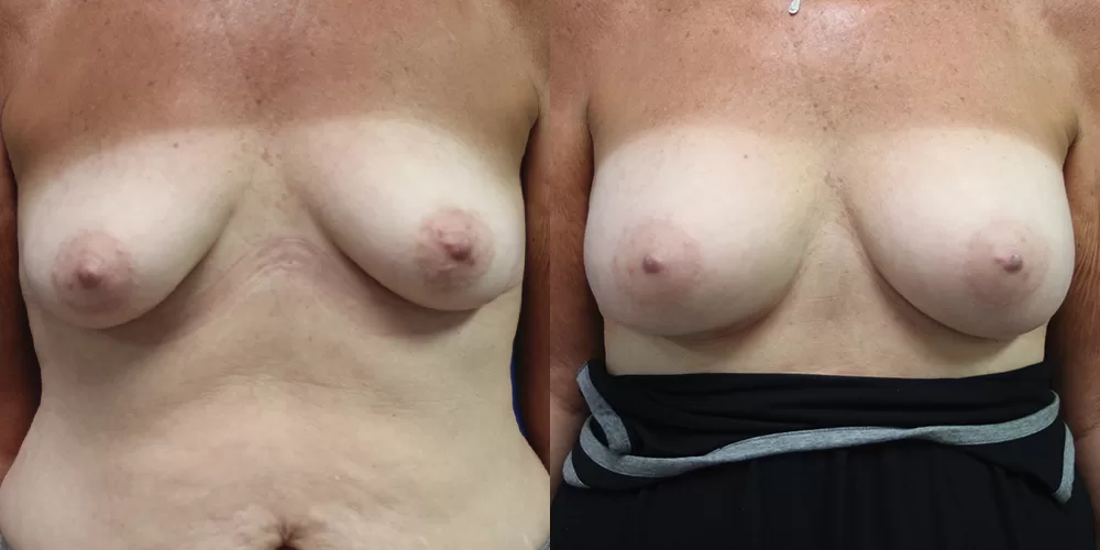 Patient 38a breast augmentation before and after