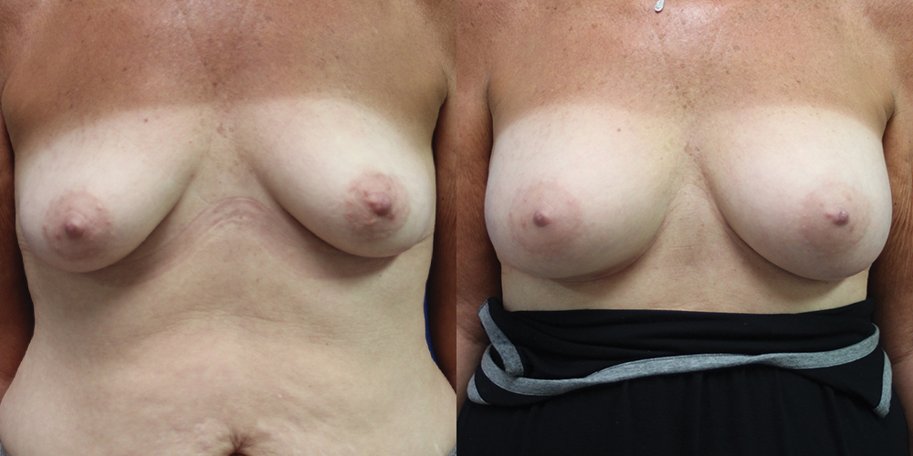 Patient 38a Breast Augmentation Before and After
