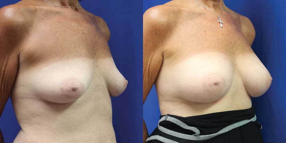 Patient 38b breast augmentation before and after