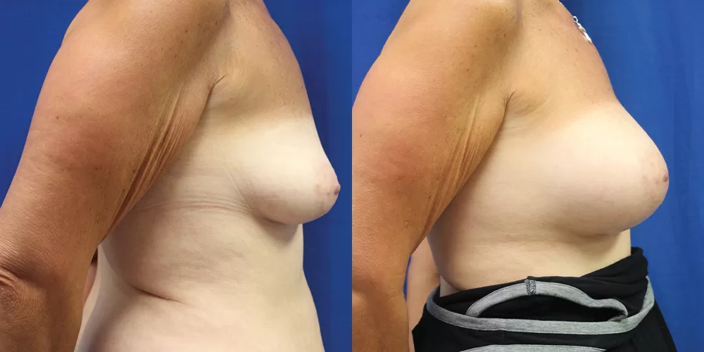 Patient 38c breast augmentation before and after