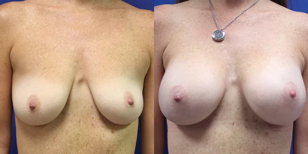 Patient 39a breast augmentation before and after