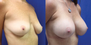 Patient 39b Breast Augmentation Before and After