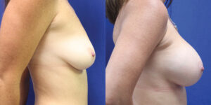Patient 39c Breast Augmentation Before and After