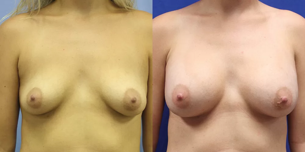 Patient 40a breast augmentation before and after