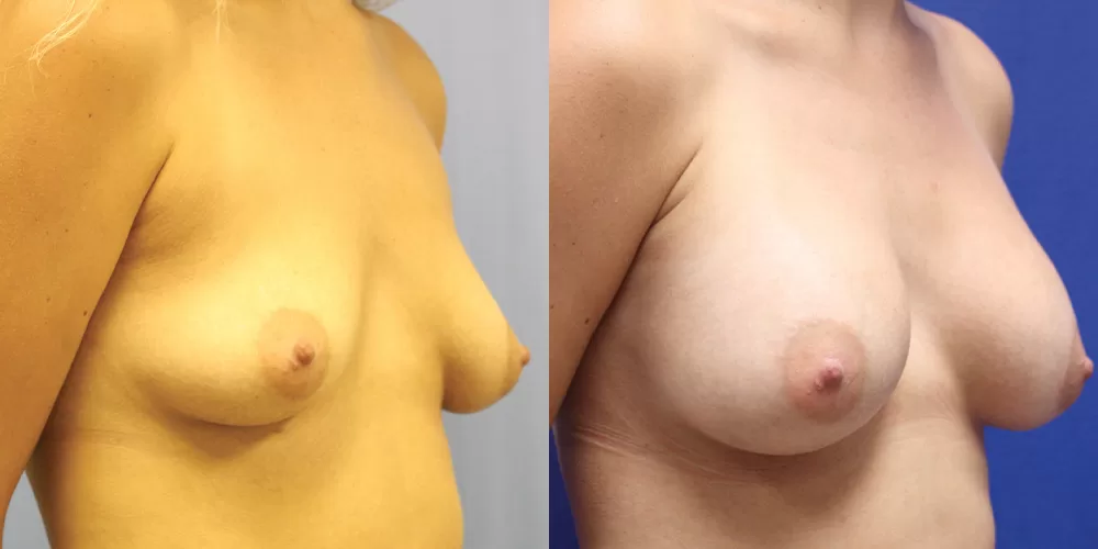 Patient 40b breast augmentation before and after