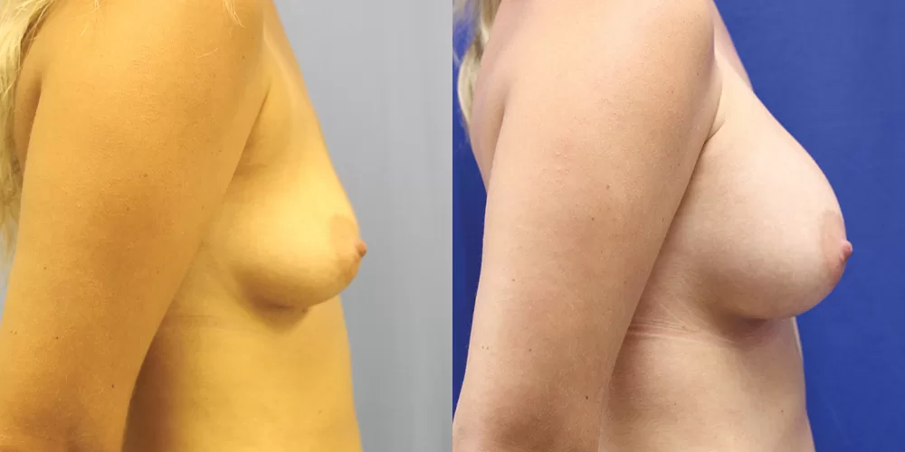 Patient 40c breast augmentation before and after
