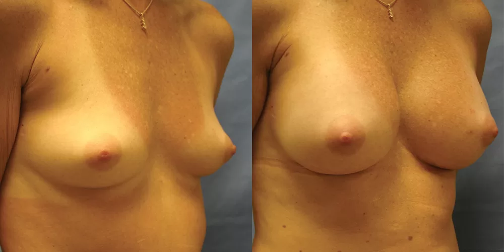 Patient 41b breast augmentation before and after