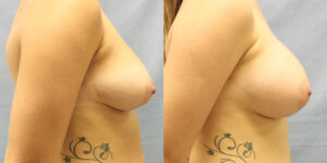 Patient 42c Breast Augmentation Before and After